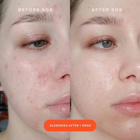 Tower 28 Beauty
SOS Intensive Redness Relief Serum with Hypochlorous Acid